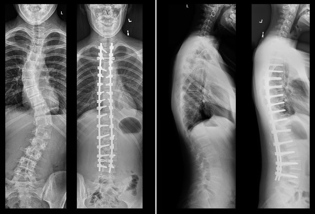 Author's Daughter Spinal X-Rays Before And After Fusion Surgery