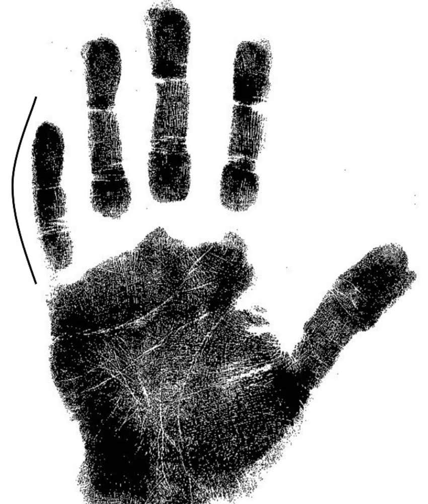 Palm print of hand showing curved little finger