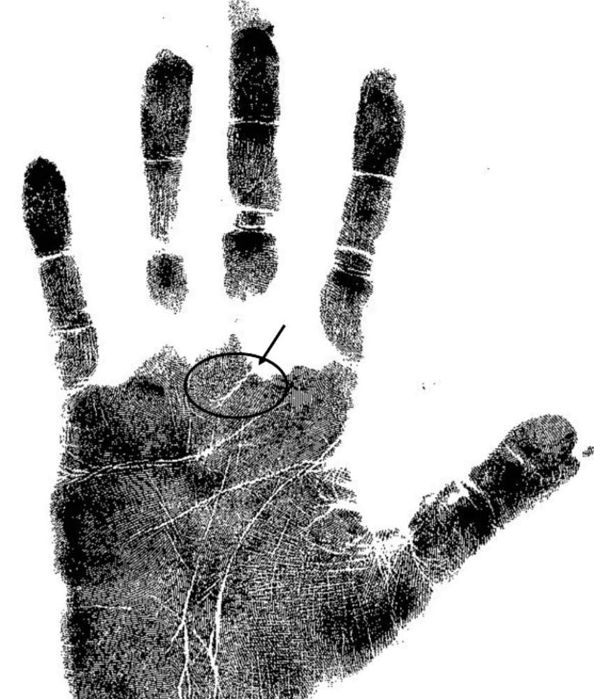 Palm print of hand with heart-line circled