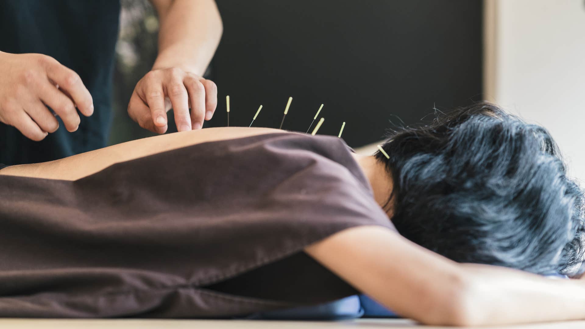 woman getting acupuncture on her back