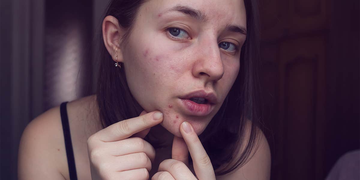 woman popping pimple around mouth