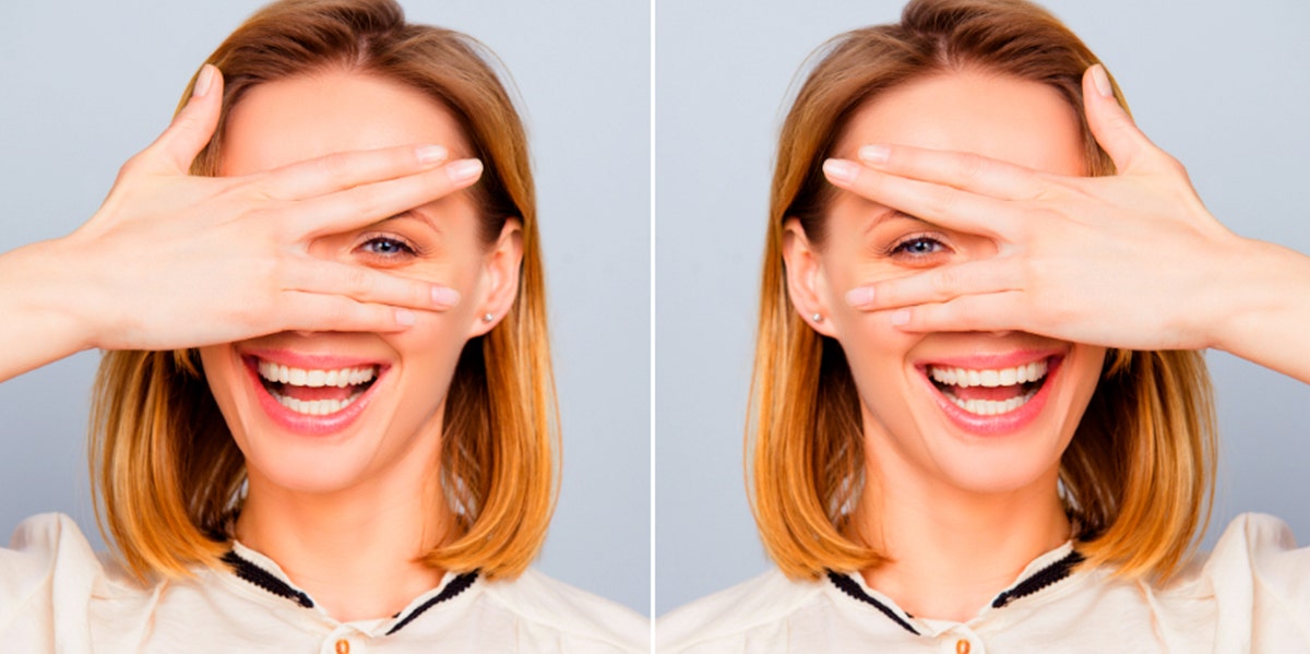 This Woman's Accutane Before/After Photos Are Going Viral For Very Good Reason This Woman's Accutane Before/After Photos Are Going Viral For Very Good Reason