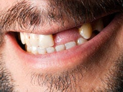 Study Links Erectile Dysfunction To Poor Dental Hygiene