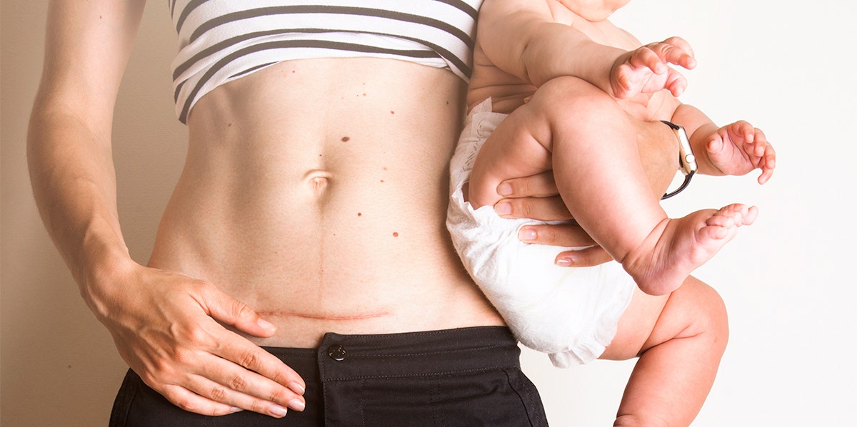 woman with c section scar holding baby 