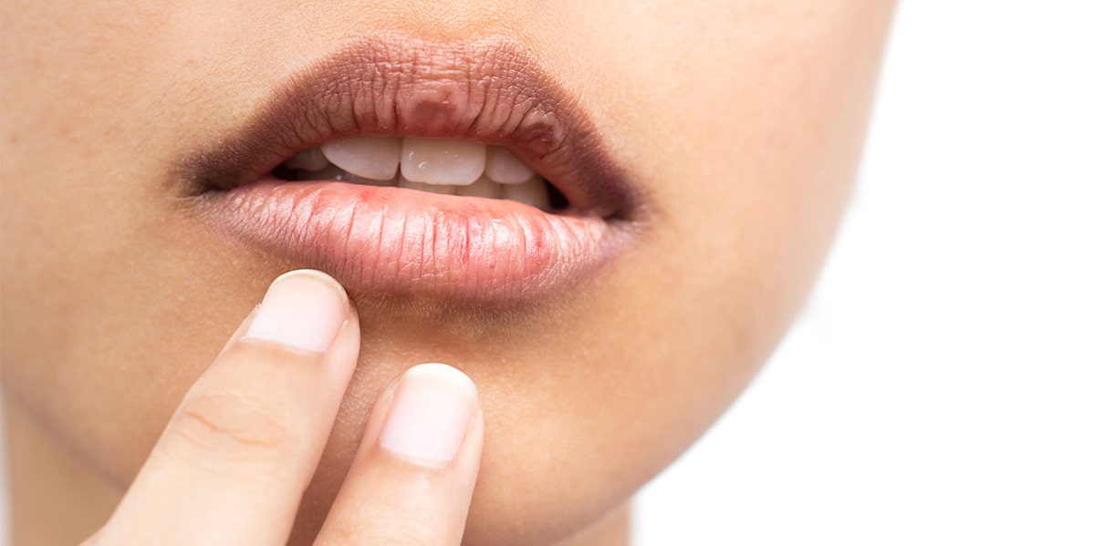 Peeling Or Chapped Lips? Something You Eat Might Be To Blame Peeling Or Chapped Lips? Something You Eat Might Be To Blame