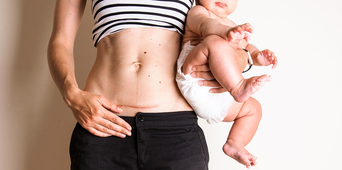 I Was Bullied Into Having A C-Section I Was Bullied Into Having A C-Section