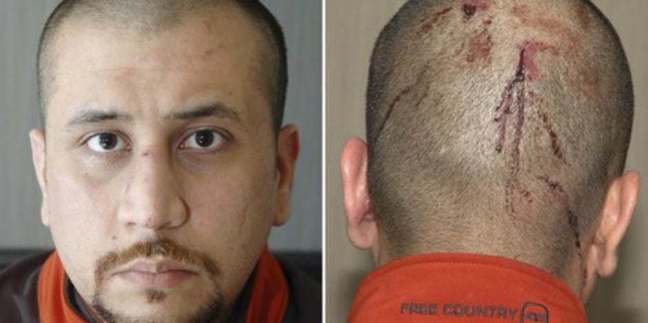 George Zimmerman with a bloody head shortly after his scuffle with his alleged murder victim, Trayvon Martin
