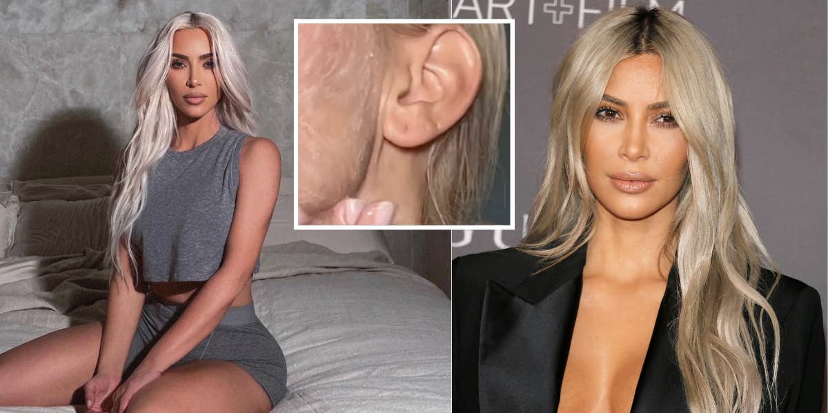 Kim Kardashian, alleged facelift scar