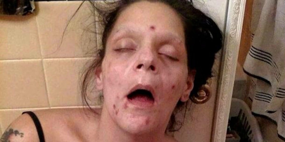 Recovering Addict Shares The Devastating Before And After Photos Of Drug Addiction recovering addict