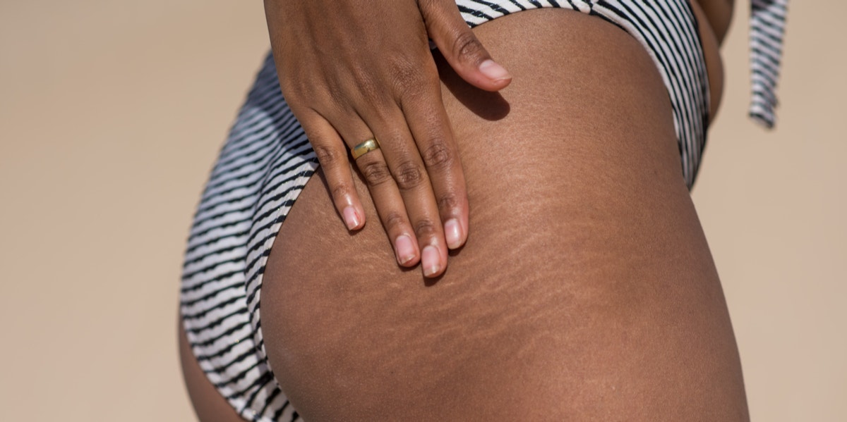 I'm Not Ashamed Of My Stretch Marks — But I Won't Share Them On Facebook stretch marks