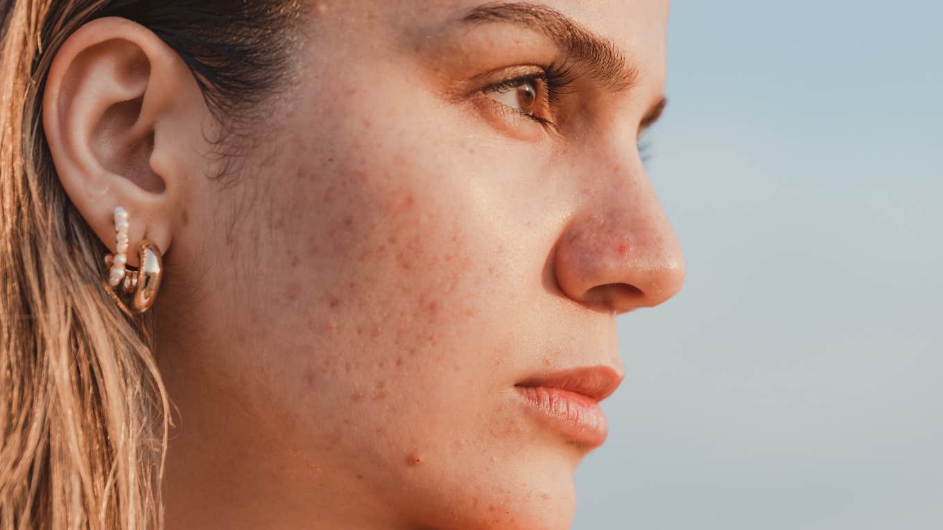 woman with acne