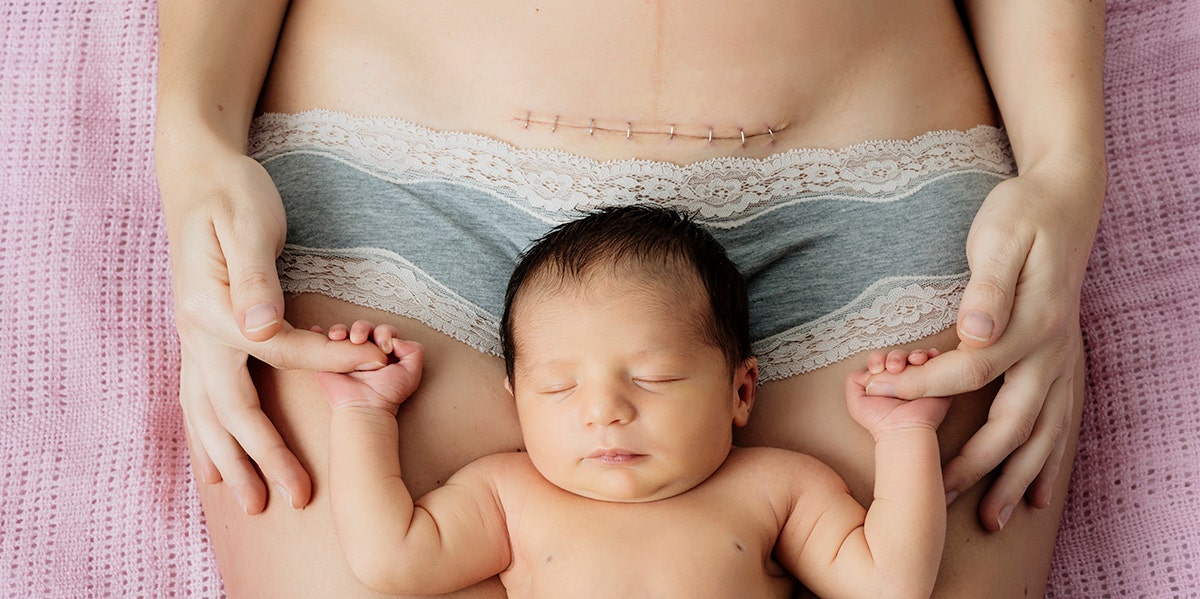 The Beautiful Reason This Mom's C-Section Scar Went Viral The Beautiful Reason This Mom's C-Section Scar Went Viral