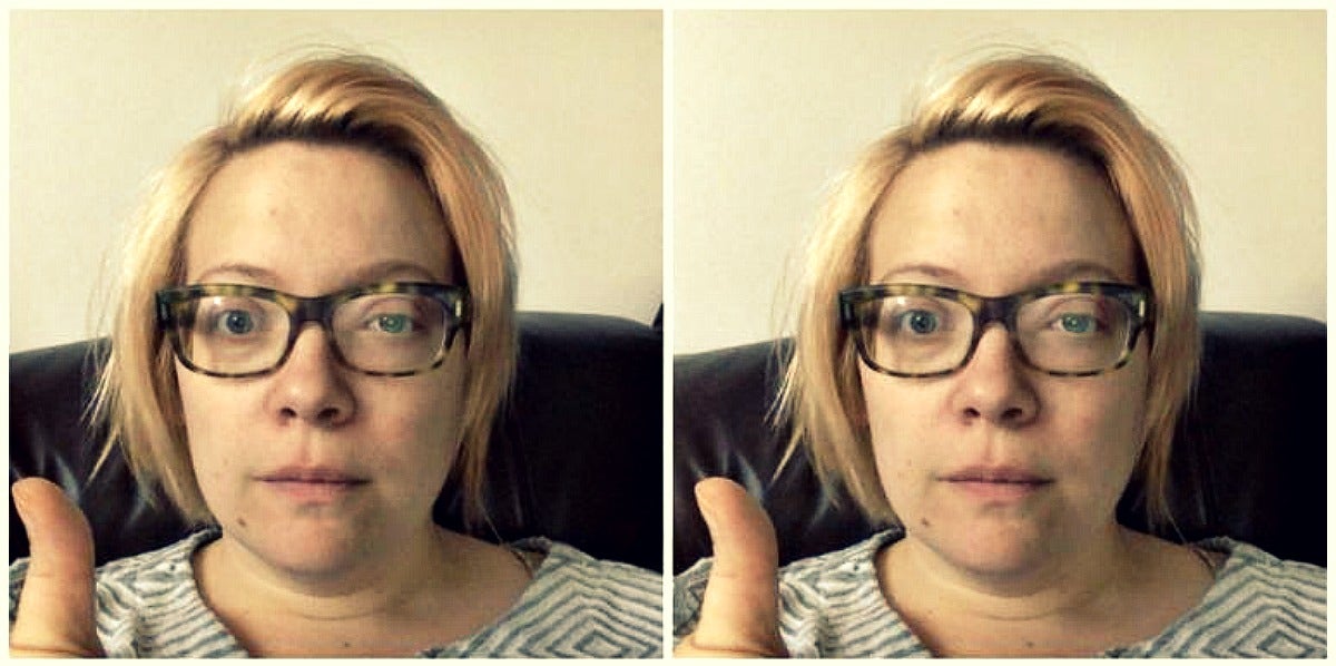 blonde woman in glasses with a shingles rash on her eye gives a wary thumbs-up