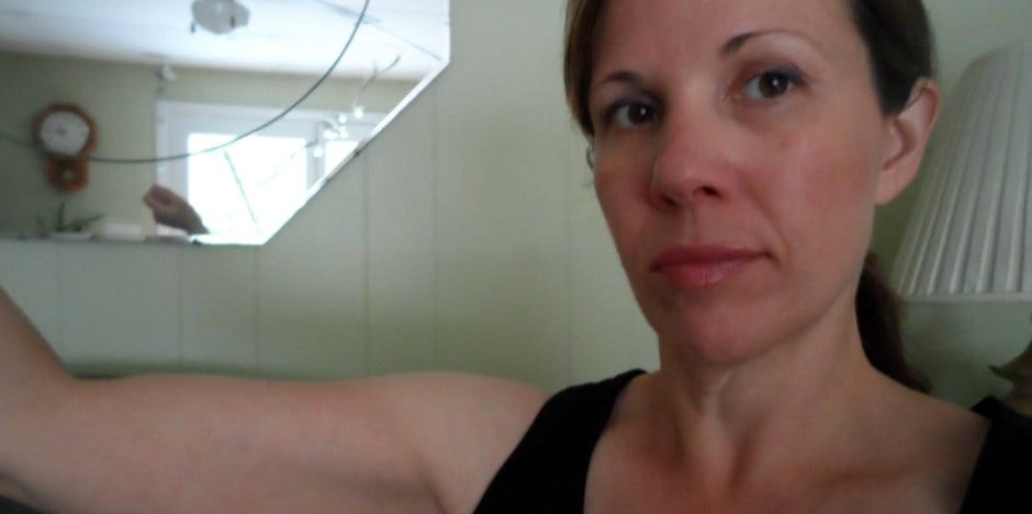 Why I Won't Have Excess Skin Removal Surgery Why I Won't Have Excess Skin Removal Surgery