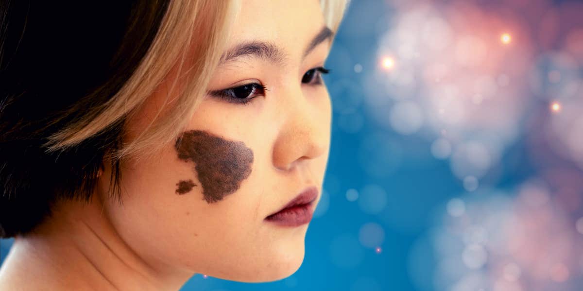 girl with mongolian birthmark