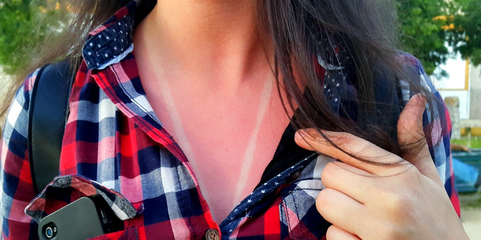 How to know if you have sun poisoning (and what to do about it)