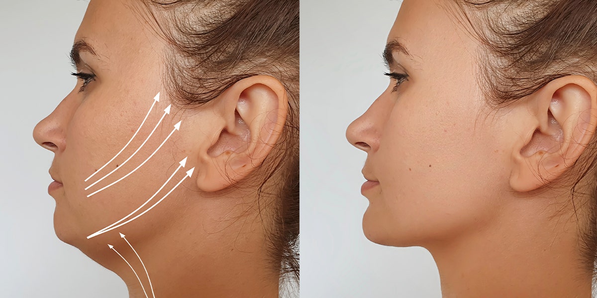 This Wild New Facelift Uses Thread To Literally Lift Your Face facelift before and after