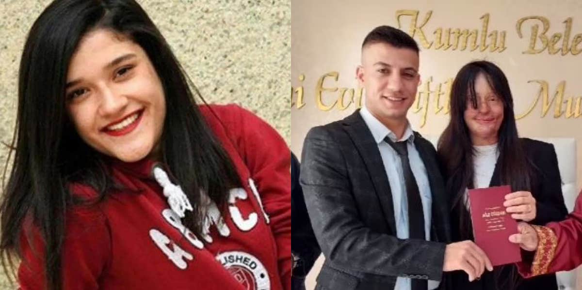 Woman Marries Man Who Threw Acid At Her In Attack Berfin Ozek, Casim Ozan Celtik