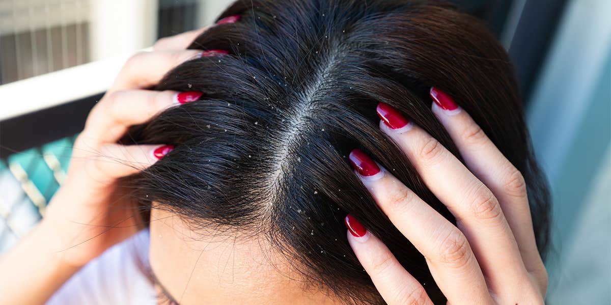 woman with dandruff on scalp