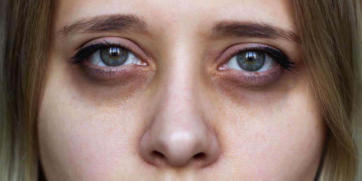 4 Ways to Reduce Bags Under Your Eyes | Dr. Malena Amato