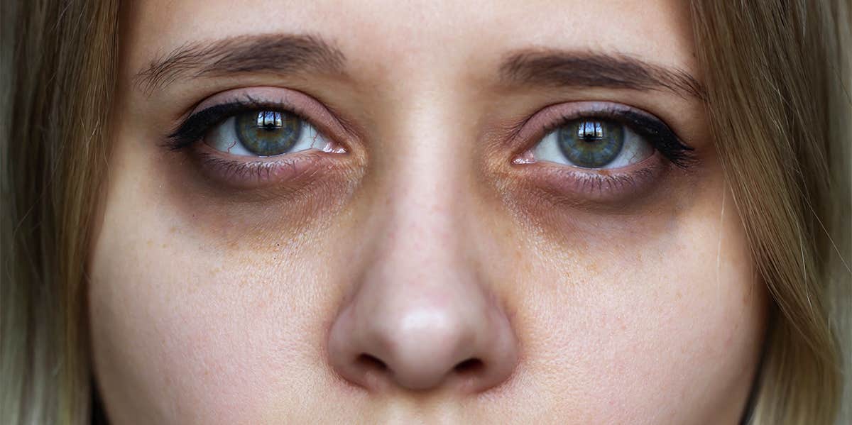 woman with dark circles