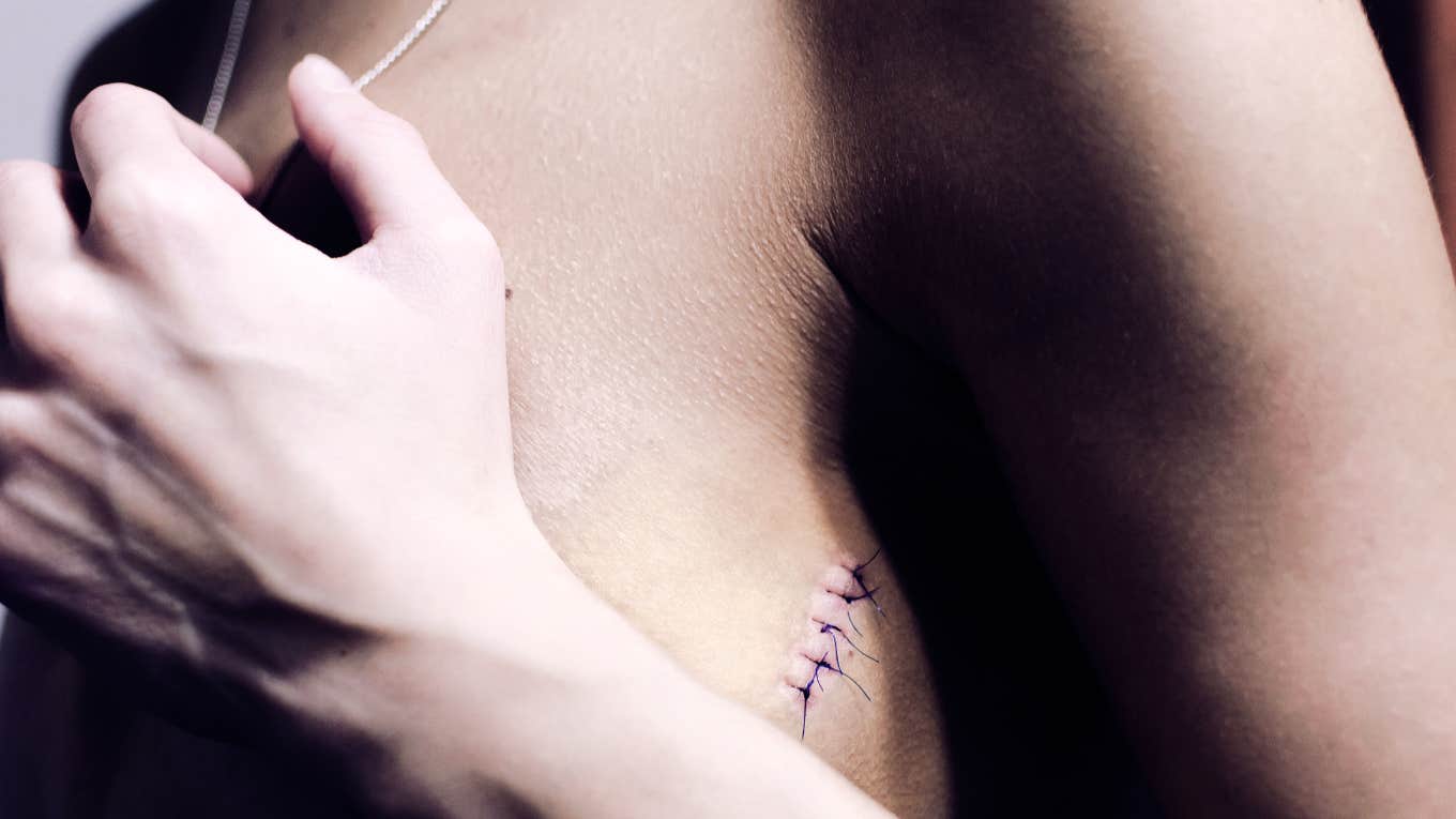 Woman showing her breast cancer scar