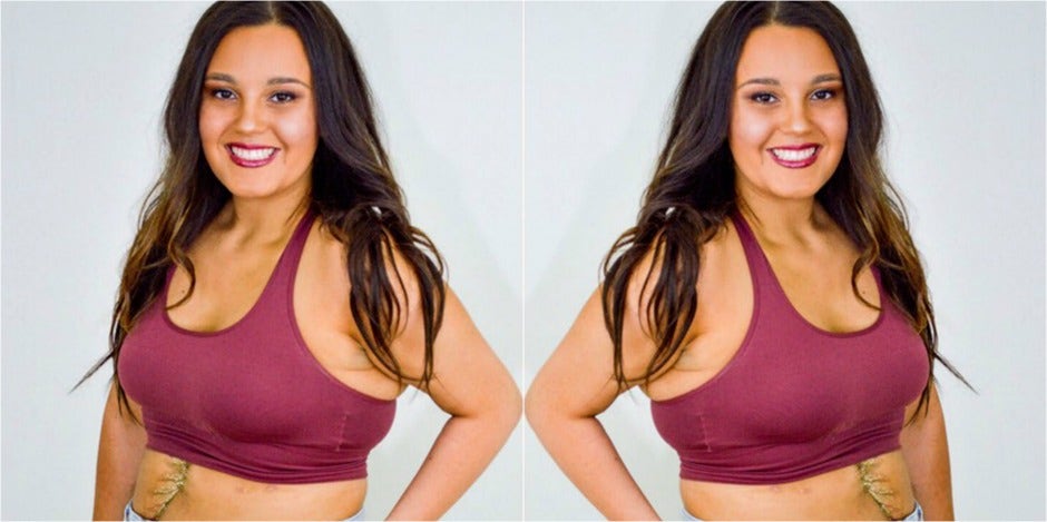 Who Is Gina Arnold? 22-Year-Old Woman Who Survived Freak Seatbelt Accident Slicing Stomach In Half
