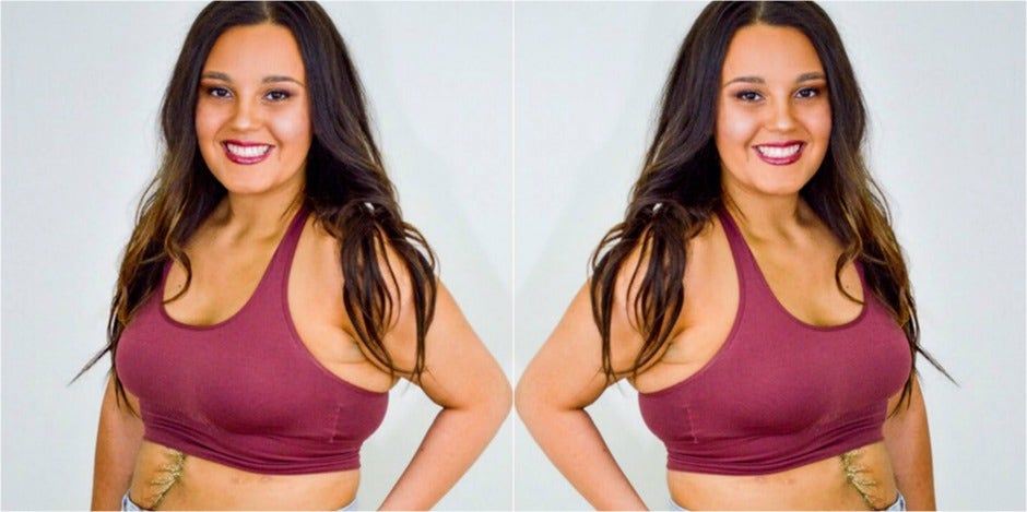 Who Is Gina Arnold? 22-Year-Old Woman Who Survived Freak Seatbelt Accident Slicing Stomach In Half Who Is Gina Arnold? 22-Year-Old Woman Who Survived Freak Seatbelt Accident Slicing Stomach In Half
