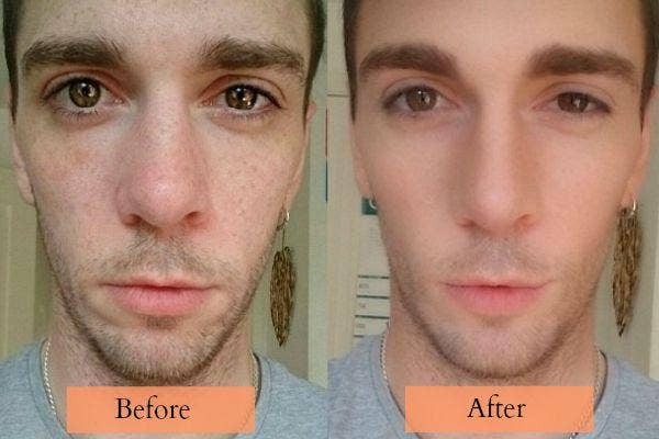 Creag suffers from psoriasis.