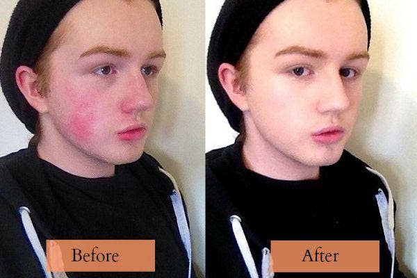 Alex with Rosacea.