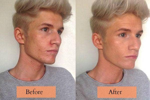 Danny and acne scars.