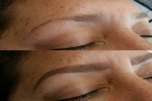 Eyebrow Tattoo Removal in Dubai, Abu Dhabi & Sharjah | Price & Cost