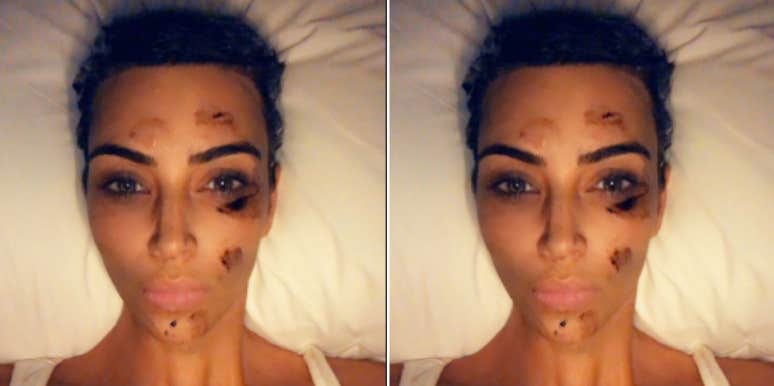 What is Psoriasis? 5 Things To Know About The Skin Condition Kim Kardashian West Has