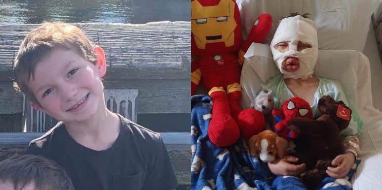 Boy Burned In Attack By Bully Who Threw Fireball Boy Burned In Attack By Bully Who Threw Fireball