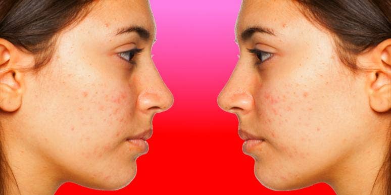 what causes acne what causes acne