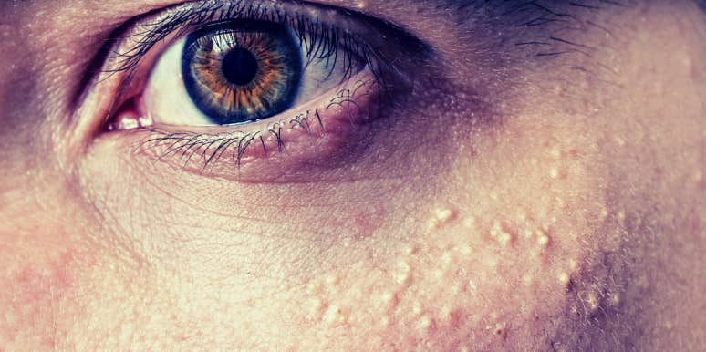 What It Means If You Have Bumps Under Your Eyes person with bumps under eyes