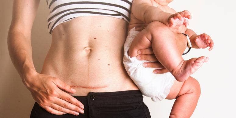 I'm Sick Of Being Told I Took The 'Easy Route' By Having A C-Section woman with c section scar holding baby