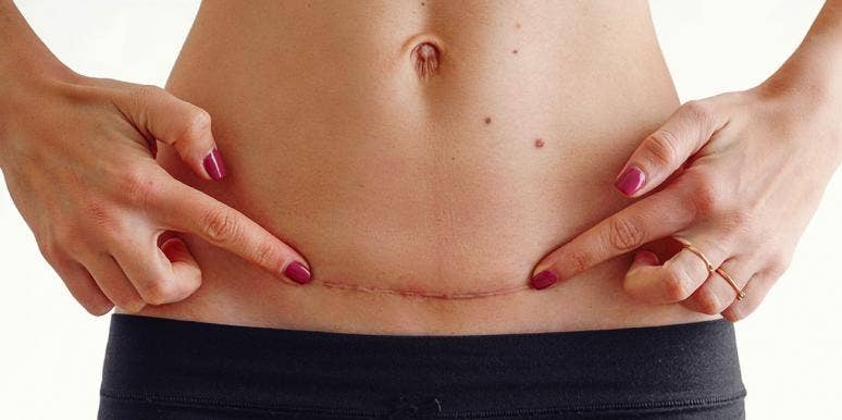 3 Truths About C-Section Moms That Need To Be Said Out Loud woman pointing at her c-section scar