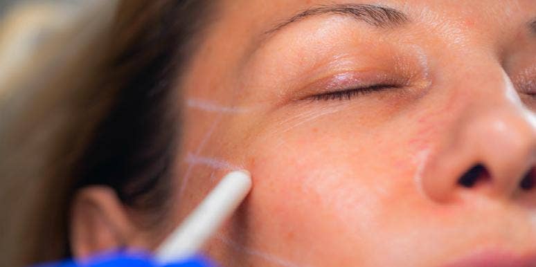 Whoa! This New Facelift Uses Thread To Lift Your Face — Watch Video Whoa! This New Facelift Uses Thread To Lift Your Face — Watch Video