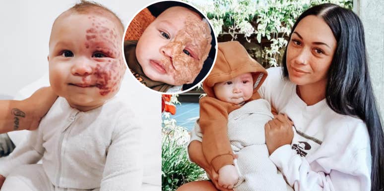 Mom Defends Herself After Video About Lasering Son’s Birthmark Draws Criticism On TikTok Brooke Atkins, Kingsley