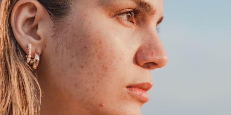 woman with acne