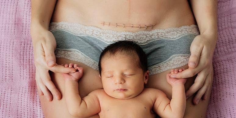 The Beautiful Reason This Mom's C-Section Scar Went Viral The Beautiful Reason This Mom's C-Section Scar Went Viral