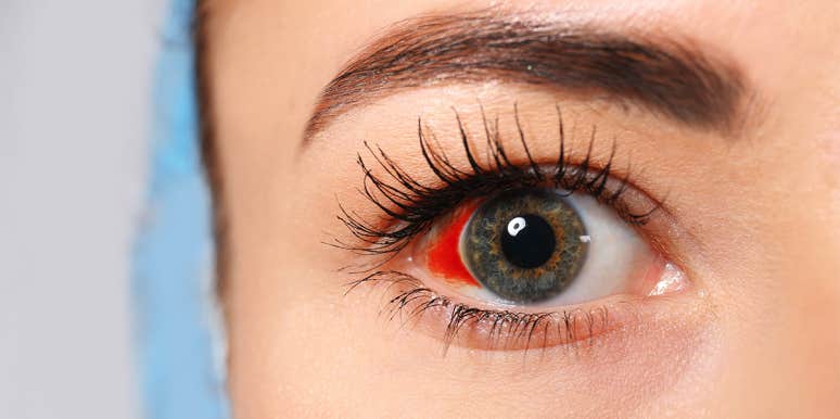 woman with broken blood vessel in eye