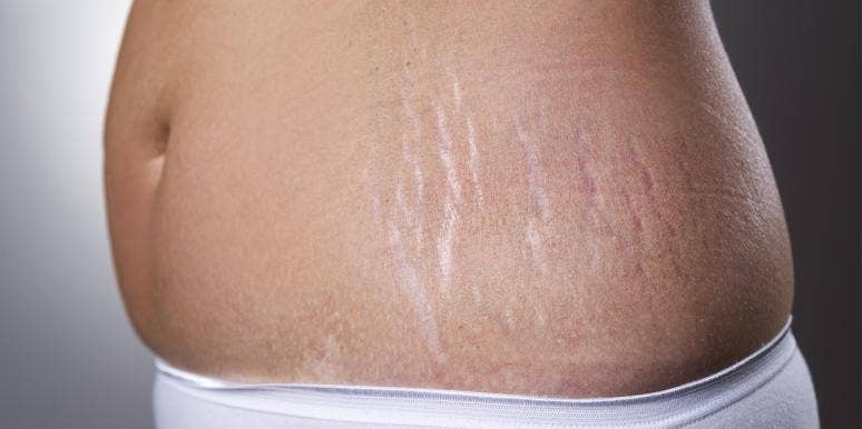 I Love My Stretch Marks — I'm A Tiger Who's Earned Her Stripes I Love My Stretch Marks — I'm A Tiger Who's Earned Her Stripes