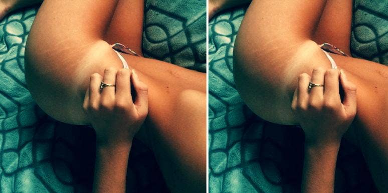 stretch marks stretch marks