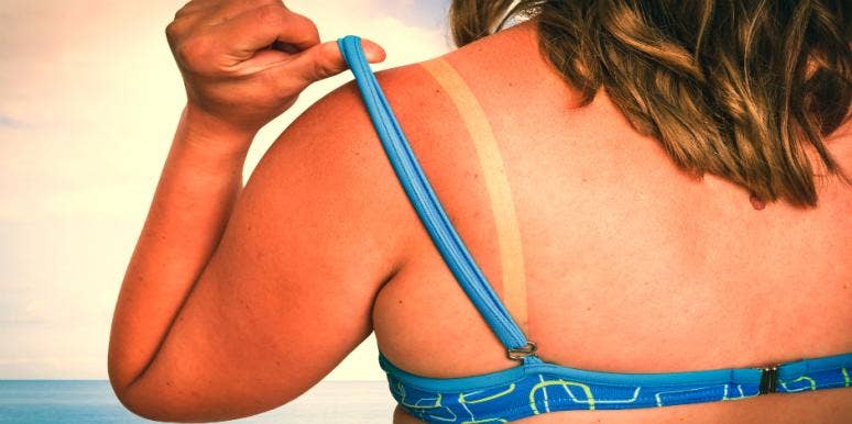 Sunburn Remedies You Can Do At Home Sunburn Remedies You Can Do At Home