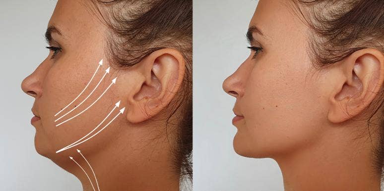 This Wild New Facelift Uses Thread To Literally Lift Your Face facelift before and after