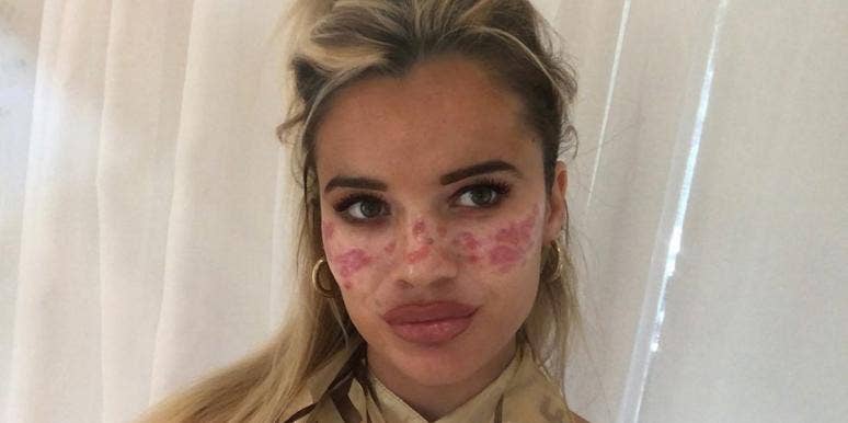 Tilly Whitfield Says TikTok Freckle Trend Caused Scars & Vision Loss Tilly Whitfield