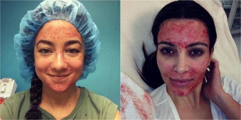 vampire facial vampire facial