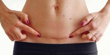 woman pointing at her c-section scar